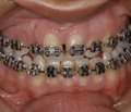 Intraoral Distraction Devices in Correction of Maxillary Deformity in Cleft Patients