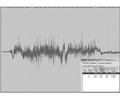 Electromyographic diagnosis of tongue motility disorders of neurogenic origin in patients with occlusive pathology