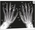 Calcinosis in systemic sclerosis: prevalence, clinical picture, management, complications