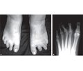 Weil Osteotomy in the Surgical Treatment of Metatarsalgia