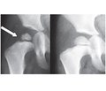 Formation of avascular necrosis of the femoral head in drug treatment of developmental hip dysplasia and congenital hip dislocation