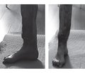 Improvement of transosseous osteosynthesis with ring fixators in the treatment of tibial nonunions