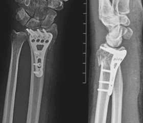 Fixation of AO 23-C severe radius fractures using volar plate. Analysis of the causes of treatment complications