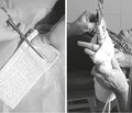 New opportunities for the comprehensive rehabilitation of patients with distal metaphyseal radius fractures using the semi-rigid fixation system