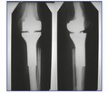 Особливості ендопротезування колінного суглоба при пухлинах кісток, коли спостерігається дефіцит м’яких тканин