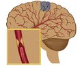 Features of Combined Neuroprotection in Ischemic Stroke