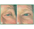 Reconstructive surgery of eyelids: aesthetic or medical aim?