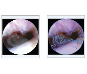 Поліпшення оцінки ушкоджень барабанної перетинки за допомогою налаштовуваного алгоритму Flood Fill