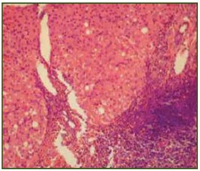 Хронический гепатит С и синдром перегрузки железом