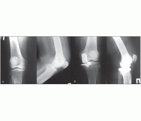 Клінічні результати одновиросткового ендопротезування колінного суглоба при медіальному остеоартрозі