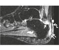 Біомеханічний аналіз поведінки структур заднього відділу стопи в акті ходьби при зап’ятковому бурситі й синдромі Haglund