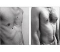 Our experience of using Nuss thoracoplasty as a method of correction of pectus excavatum