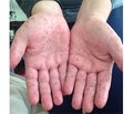 Diagnostic and Therapeutic Difficulties in Children with Viral Exanthema in the Practice of General Practitioners