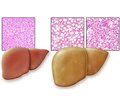 Non-alcoholic fatty liver disease: time for changes