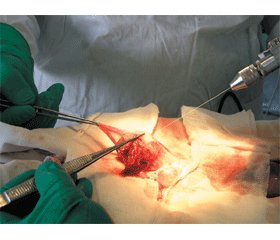 Хірургічне лікування запальних і спайкових процесів черевної порожнини у підлітків із використанням струменевого гідроскальпеля
