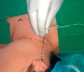 Combined Regional Anesthesia during Surgeries on the Thyroid Gland