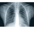 Case of a fatal lung disease in a child with juvenile dermatomyositis