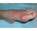 Clinical and Prognostic Significance of Serum Uric Acid as a Marker Complicated Course of Gout on the Background Pathology of Digestive Tract