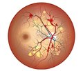 Prediction model for severity of diabetic retinopathy derived from review of endothelial dysfunction and hypoxia markers