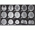 Спадкова мозочкова атаксія: особливості діагностики та перебігу
