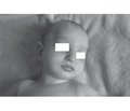 Experience of the diagnosis and observation  of a child with wolf-hirschhorn syndrome