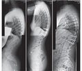 The results of treatment of uncomplicated incomplete burst fractures of thoracic and lumbar spine