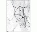 Оценка состояния вертлужной впадины при асептическом некрозе головки бедренной кости по данным рентгенморфометрических исследований
