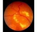 Діабетична ретинопатія: новий підхід до медикаментозного лікування (Огляд літератури)
