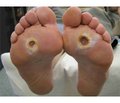 Using methods of plastic closure of defects in wound treatment of patients with diabetic foot syndrome