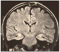 Clinical picture and diagnosis of mesial temporal sclerosis associated with herpes virus infection