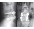 Frequency and structure of complications of early and late postoperative periods in patients with a herniated disc operated by the method of microdiscectomy