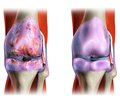 Osteoarthritis of the knee joint. Etiology, treatment, rehabilitation (analytical review of the literature)