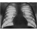 Isolated pulmonary artery stenosis: early neonatal and postnatal diagnostics, clinical manifestations, treatment and prognosis