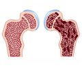 Osteoporosis in Сhildren with Itsenko — Cushing Disease: Etiology, Pathogenesis, Diagnosis