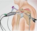 Пути оптимизации анкерной  стабилизации капсулы при открытом  и артроскопическом лечении нестабильности плечевого сустава