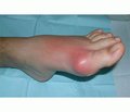 Peculiarities of clinical manifestation, course and treatment of patients with gout associated with hypothyroidism