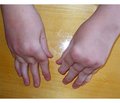 Joint Pain Perception Features in Children with Juvenile Rheumatoid Arthritis and Their Parents
