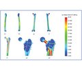 Investigation of Stress-Strain State of the Model of the Femur in Terms of Arthroplasty for its Proximal Fractures