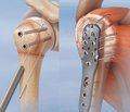 Особливості оперативного лікування застарілих поперечно-поздовжніх розривів ротаційної манжети плеча