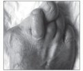 Дифференцированный подход к лечению молоткообразных деформаций пальцев стопы у взрослых