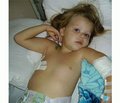 Розвиток тромбозів при гострій лімфобластній лейкемії в дітей