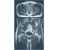 Роль інструментальних методів дослідження в діагностиці гострих післяопераційних ускладнень при ендопротезуванні кульшових суглобів