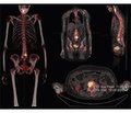 Prospects for the quantitative assessment of the results of single-photon emission computed tomography of the skeletal system (literature review)