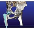 Features of the use of additive technologies in operative orthopaedics