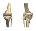 Вивчення відносних деформацій зв’язкового апарату колінного суглоба при аплазії хрестоподібних зв’язок та після їх відновлення (математичне моделювання)