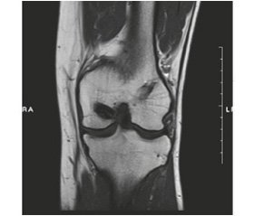 Long-term results of posterior cruciate ligament reconstruction using tibial flexor tendon autograft