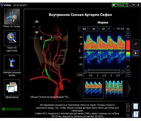 Зміни церебральної гемодинаміки за показниками ультразвукової допплерографії у хворих на гострий ішемічний інсульт у вертебробазилярному басейні
