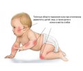 Optimizing the Treatment of Atopic Dermatitis  in Infants Using Ursodeoxycholic Acid