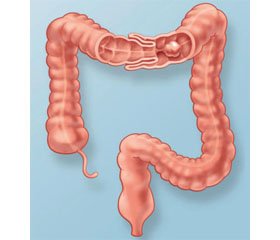 Intussusception in Children in the Practice of the Pediatrician Infectious Disease Specialist