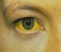 Дифференциальная диагностика желтух